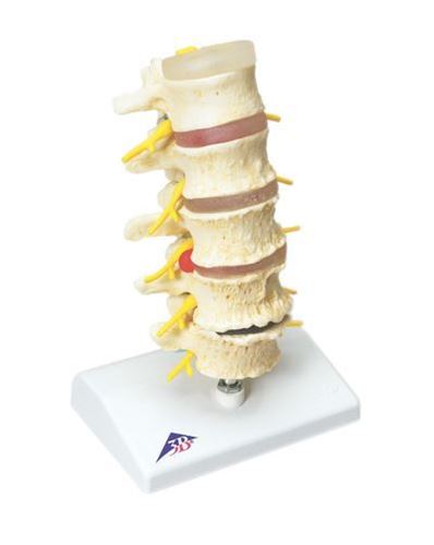 Picture of Anatomical Model - vertebrae degeneration, stages of prolapsed disc